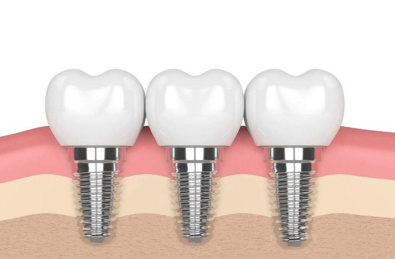 种植牙可以使用哪些器具来做个人维护