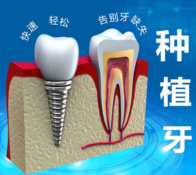 北京种植牙相对于烤瓷牙具有的优势