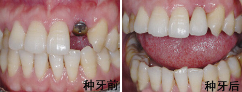 北京即刻种植多少钱