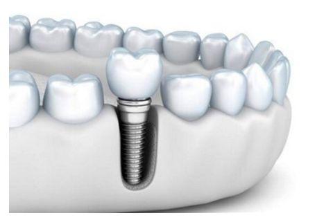 植牙优点有哪些 种植牙价格为何那么贵