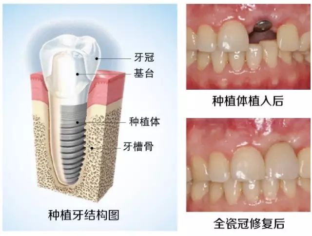多数牙缺失是什么原因造成的