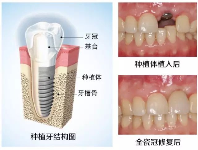 单颗牙缺失怎么修复