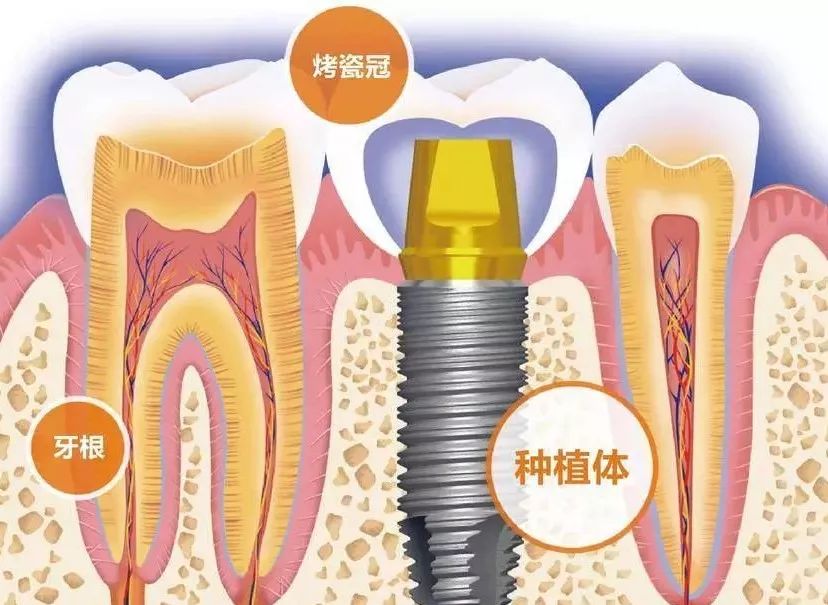 7个理由让你选择牙齿种植 种植牙的优势多