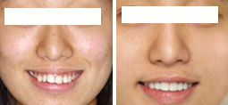 拔牙矫正牙齿，脸部会发生变化吗？