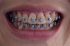 牙齿矫正的价格与哪些因素有关
