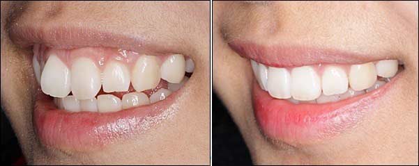 成年人矫正牙齿做美容冠能保持多久