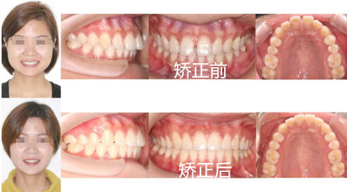 上海卢湾区隐形牙齿矫正的价格是多少