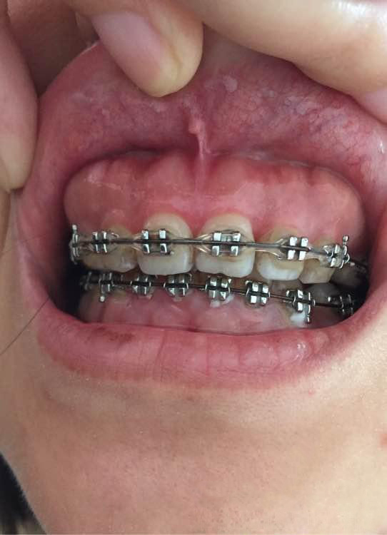 万众口腔专家解说成人牙齿整形特点