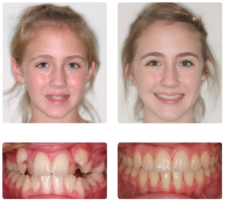牙齿矫正什么年龄会比较合适