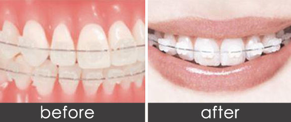 上海牙齿矫正四大方法