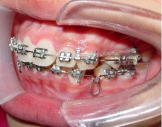 15岁男孩子牙齿不齐做矫正多少钱