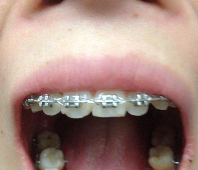 小孩换牙时可以矫正牙齿吗