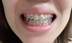 牙齿矫正的缺点
