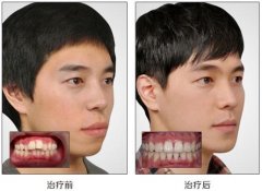牙齿正畸究竟需要多长时间？
