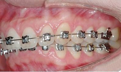 隐形牙齿矫正器的种类有哪些