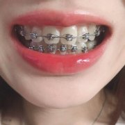 成人做牙齿矫正有危害吗 应该如何避免
