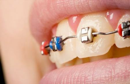 牙齿矫正的三大黄金时期是什么时候