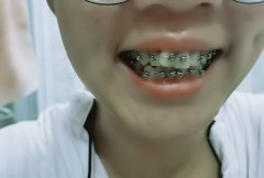 牙齿矫正年龄有要求吗