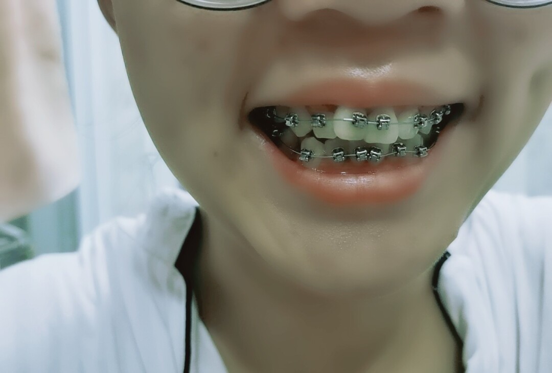 箍牙的流程