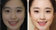 上海徐汇区做牙齿矫正多少钱