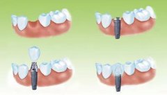 牙齿矫正一般都要经过哪些过程？