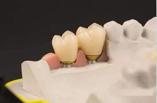 后牙种植修复后容易脱落吗？
