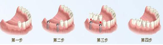 牙齿不齐矫正多少钱