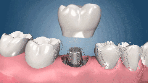 龅牙齿矫正副作用