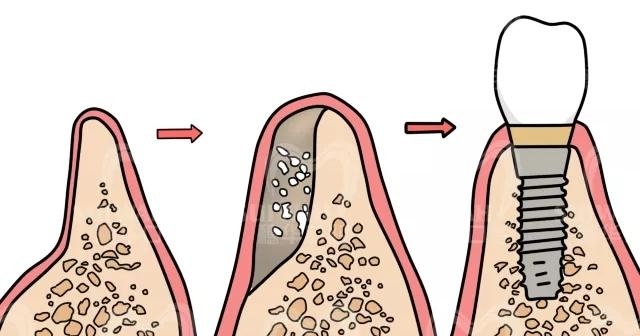 种植牙有哪些好处与危害？