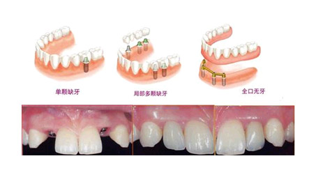 美容冠矫正龅牙价格