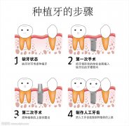 广州韩妃美人尖种植手术有哪些优点 植发医院怎么对美人尖种植