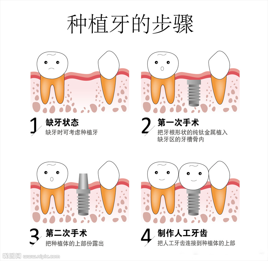 ​剧透:安徽省口腔医院种植牙价格表,内含半全口种牙费用哦