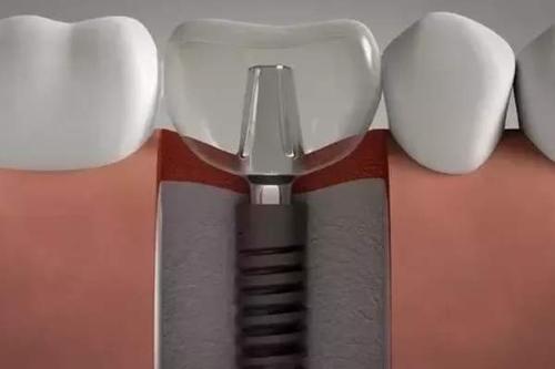 口腔牙齿隐形矫正器有哪些优点呢?