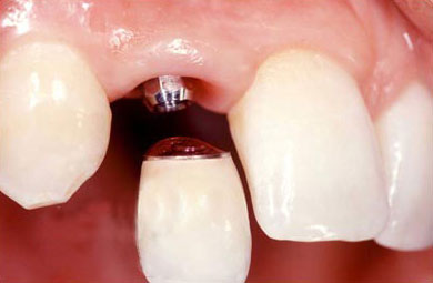 种植牙后期修复你了解吗