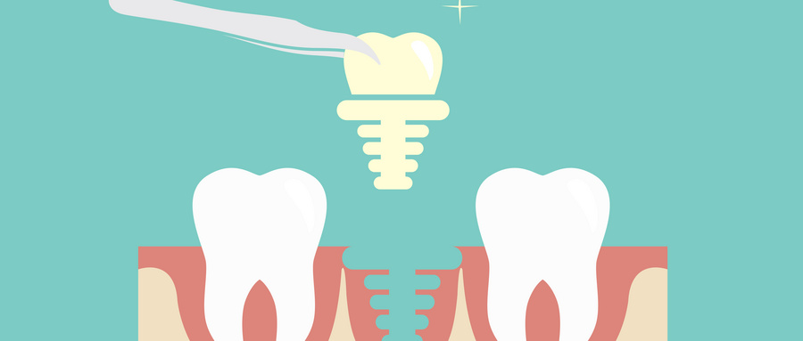 牙槽骨骨量小于7毫米无法做种植牙需要植骨,方法都有哪些?