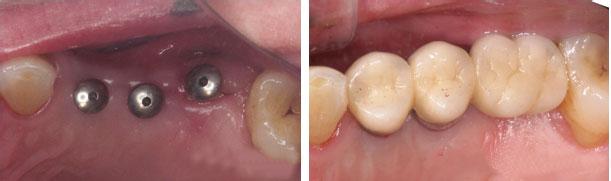 种植牙多久恢复？