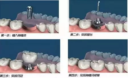 美容冠矫正牙齿如何护理