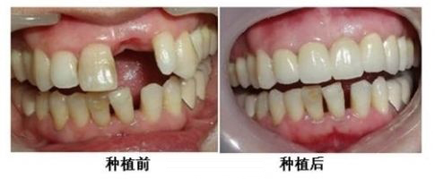 成都牙齿矫正治疗过程周期是怎样的?